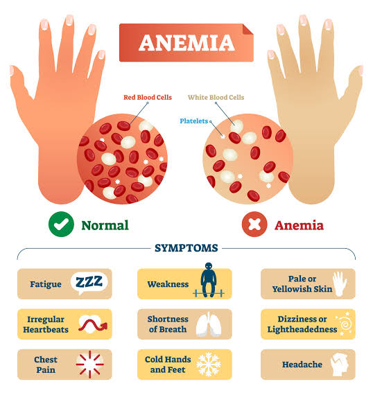 Cara Mengatasi Penyakit Anemia Dengan Tepat Reviewasik